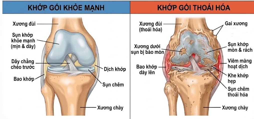 Thoai hoa khop goi