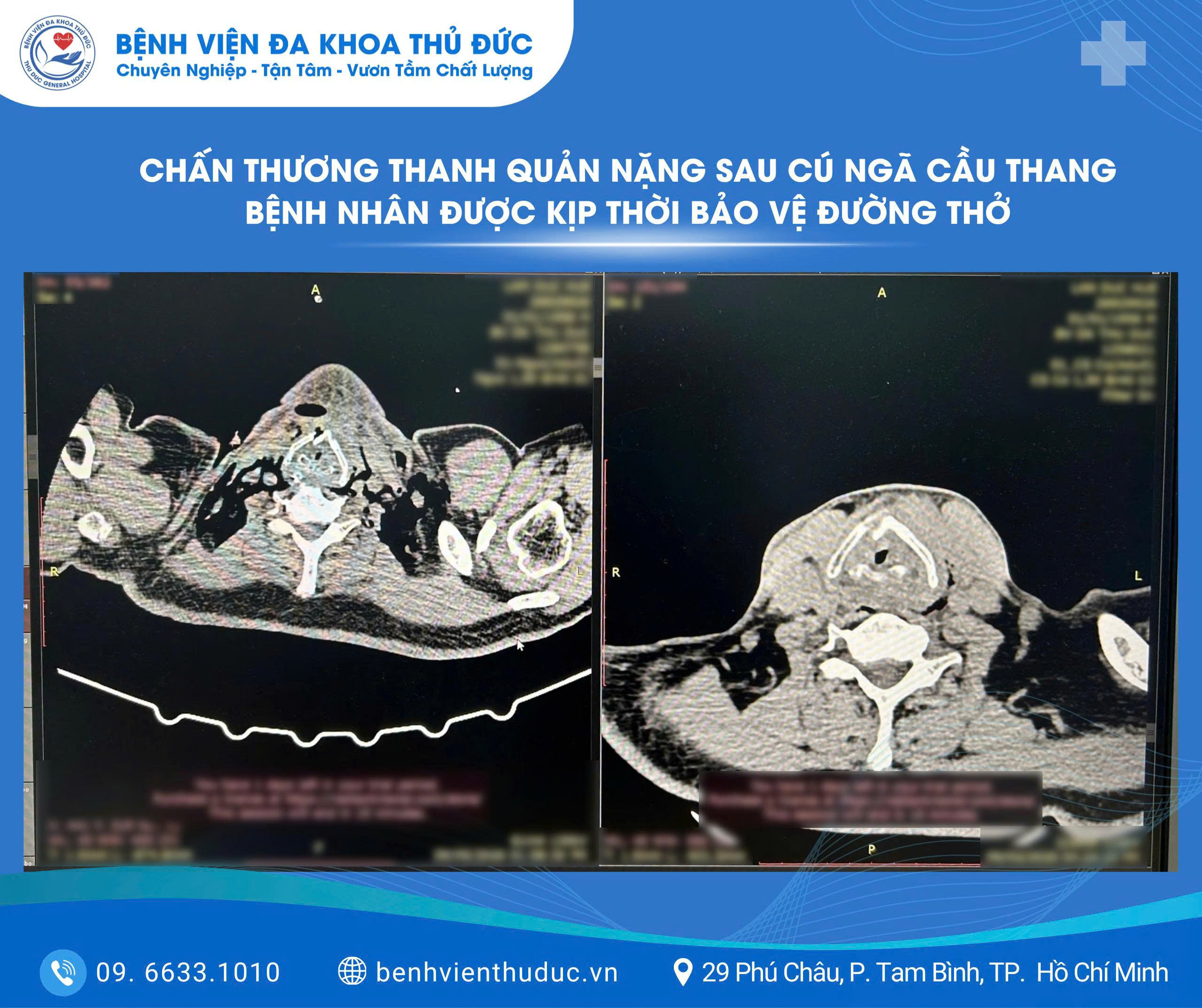 chan thuong thanh quan nang sau cu nga cau thang benh nhan duoc kip thoi bao ve duong tho 1
