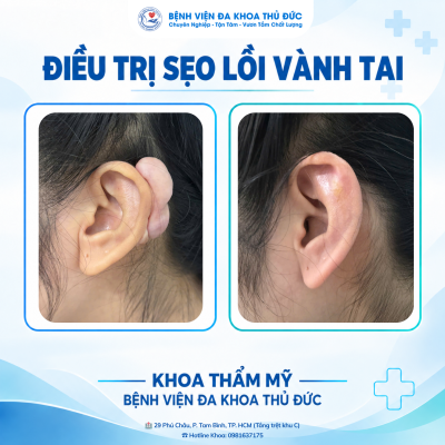 ĐIỀU TRỊ SẸO LỒI VÀNH TAI: VÌ SAO CẦN PHỐI HỢP NHIỀU PHƯƠNG PHÁP?