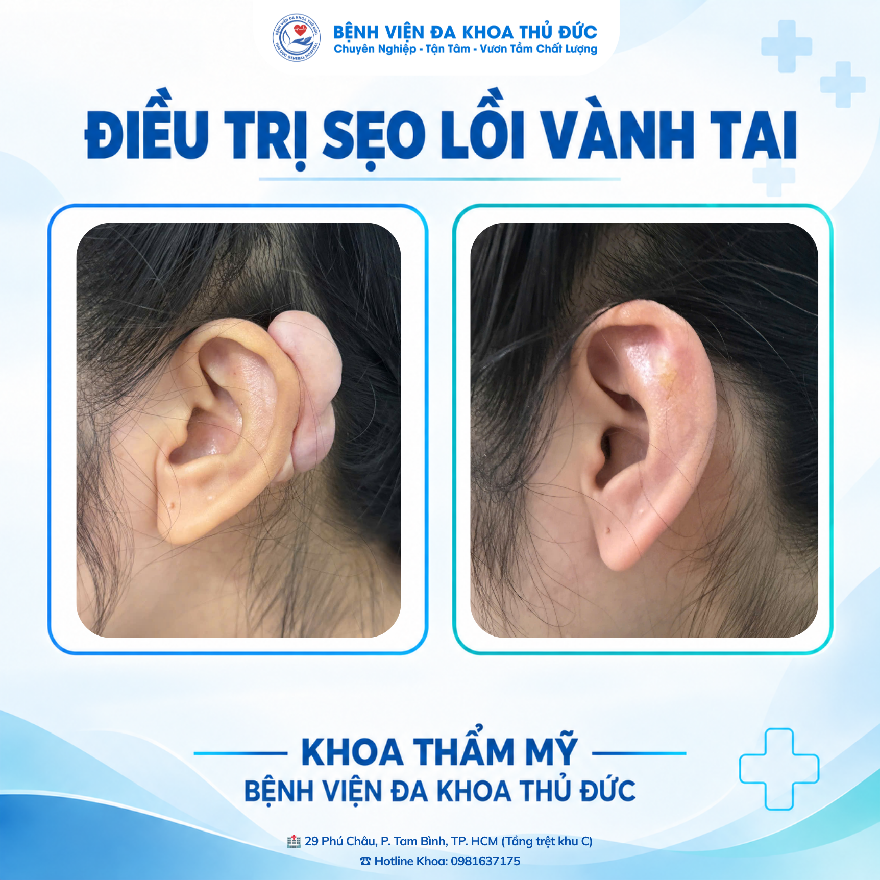 dieu tri seo loi vanh tai vi sao can phoi hop nhieu phuong phap